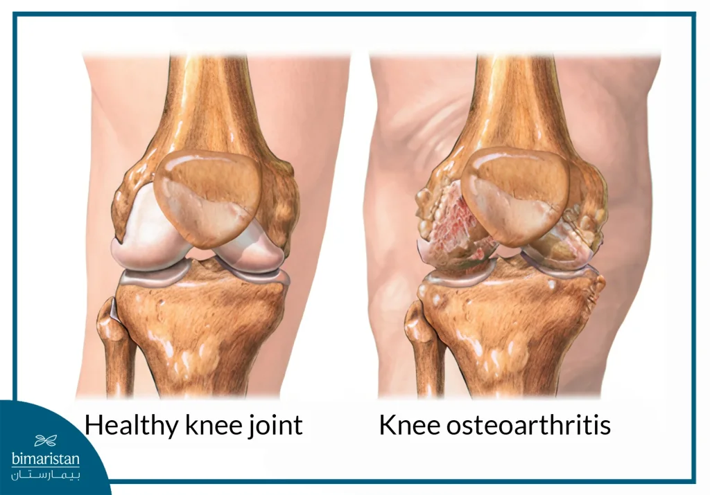 The Difference Between A Healthy Knee And  Knee Osteoarthritis