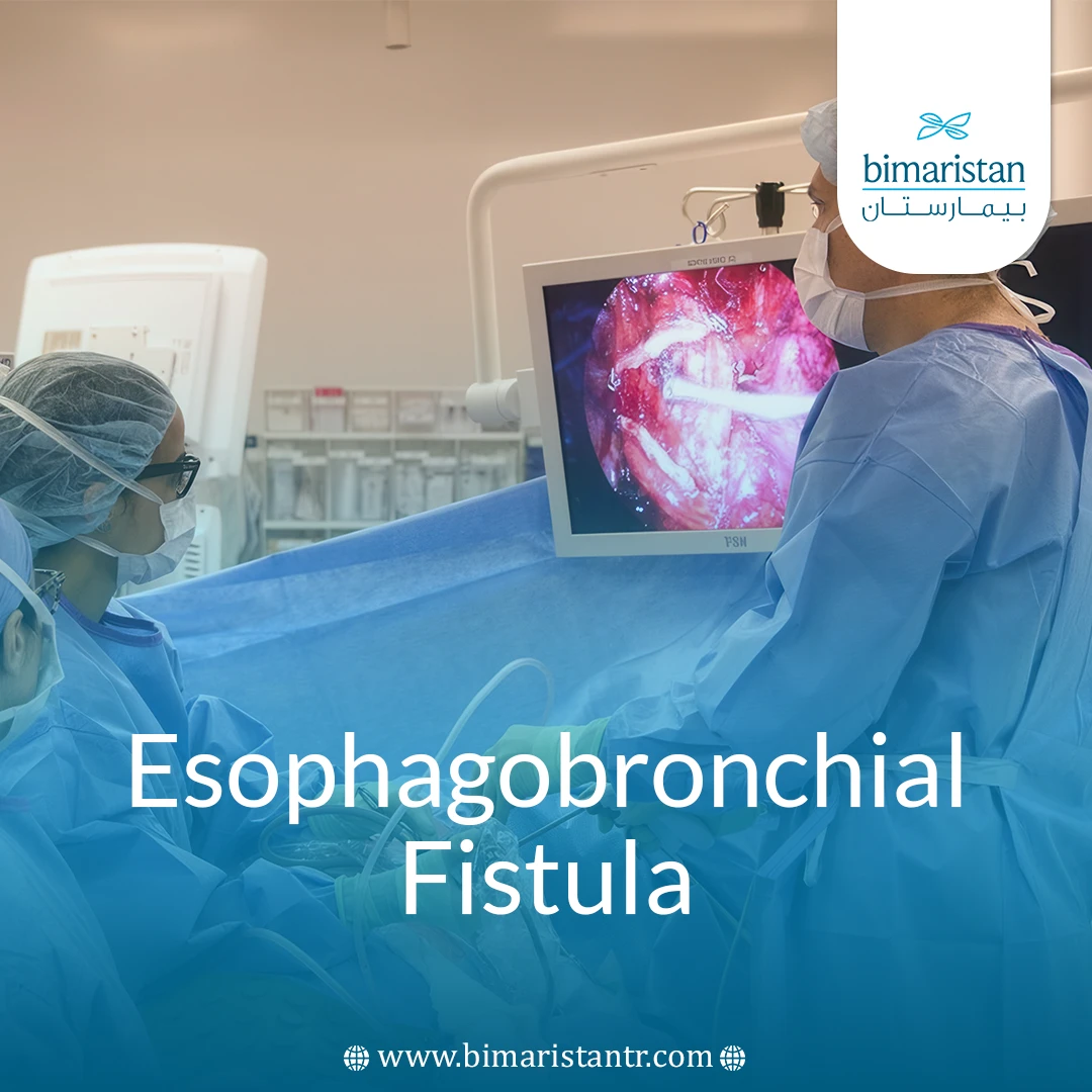 Esophagobronchial Fistula