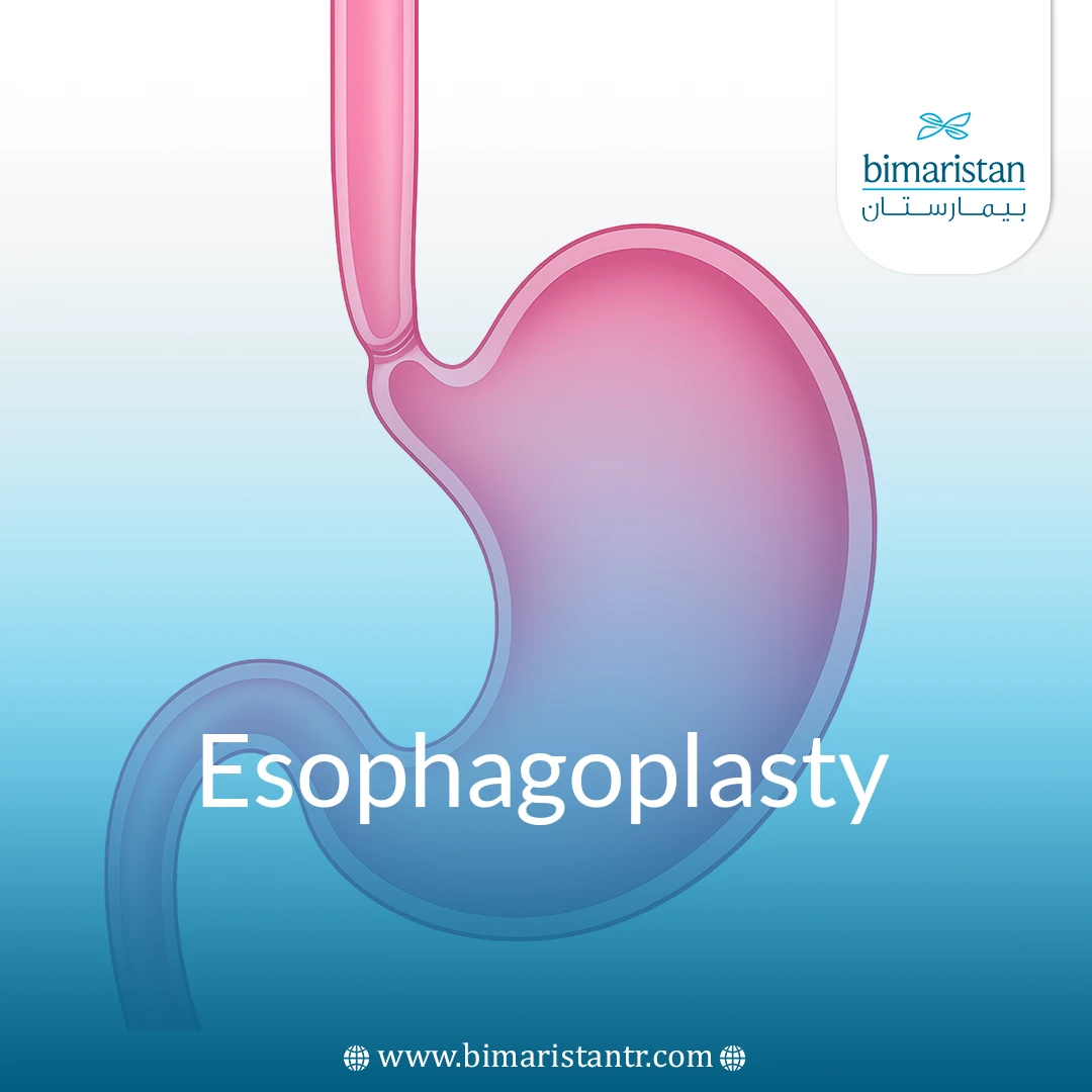 Esophagoplasty Surgery: When It’s Needed And What To Expect