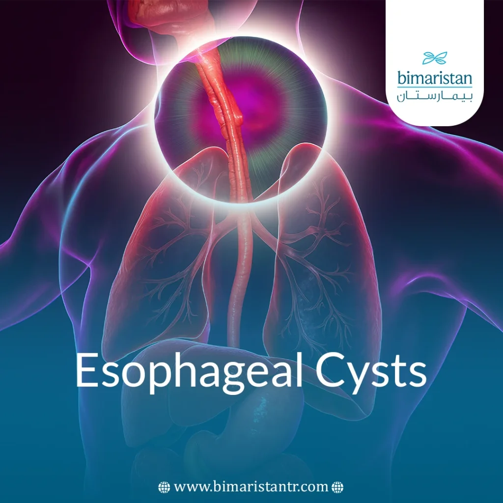 Esophageal Cysts