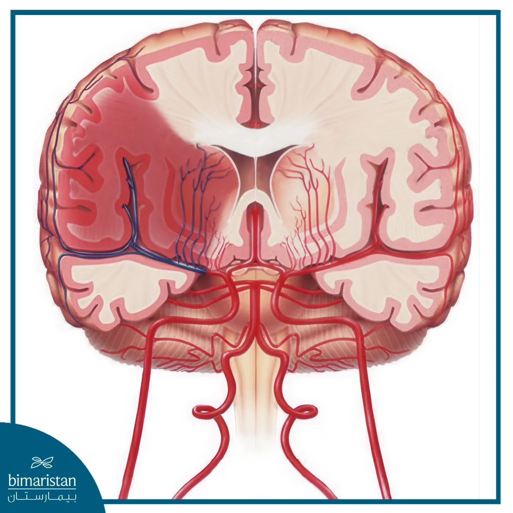 An Image Showing A Right Cerebral Hemorrhage
