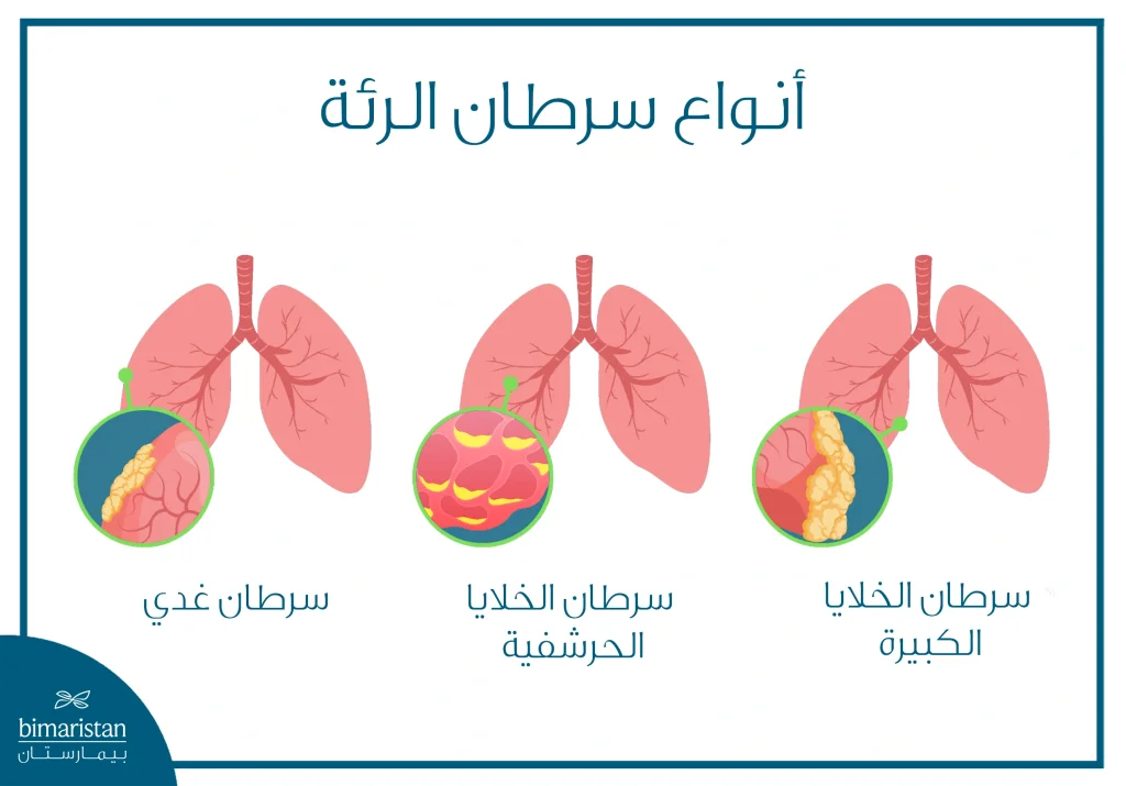 أنواع سرطان الرئة