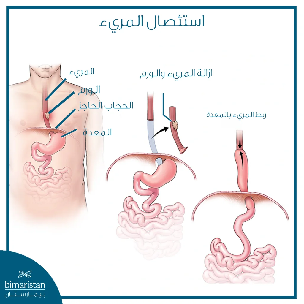استئصال المريء