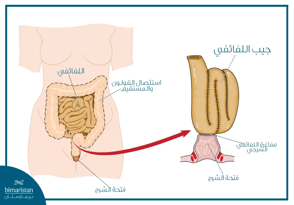علاج التهاب القولون التقرحي في تركيا 4 الصورة توضح استئصال الكولون والمستقيم مع جيب اللفائفي
