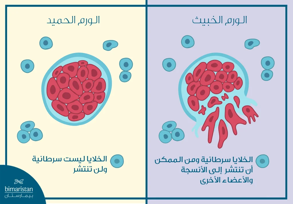 الفرق بين الأورام الحميدة والأورام الخبيثة