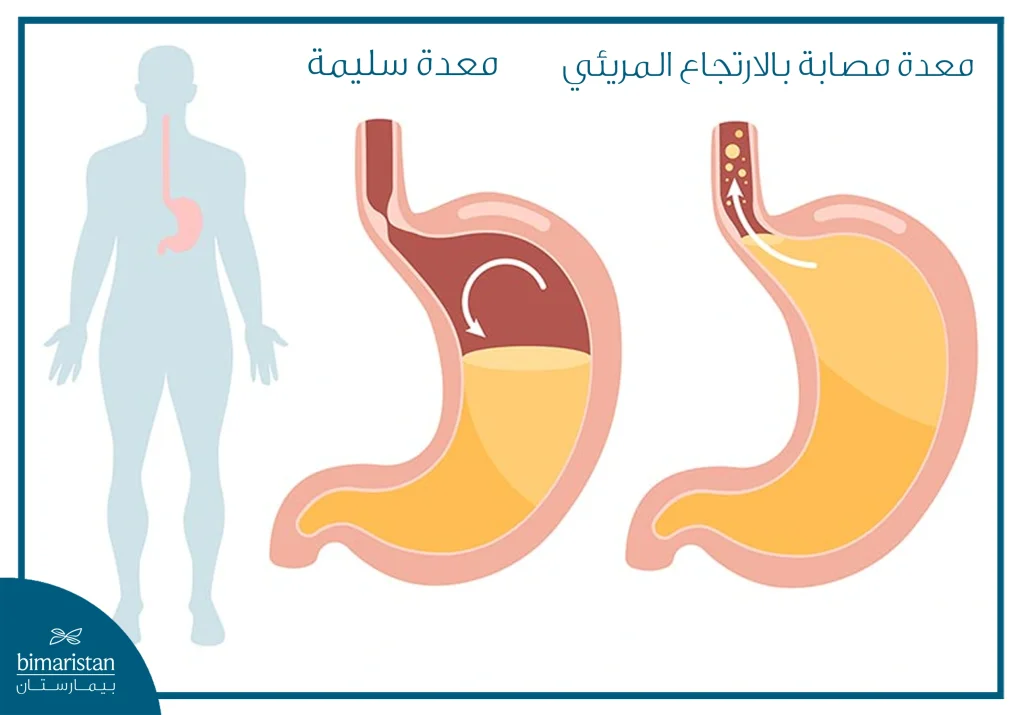 الفرق بين المعدة السليمة والمعدة المصابة بارتجاع المريء