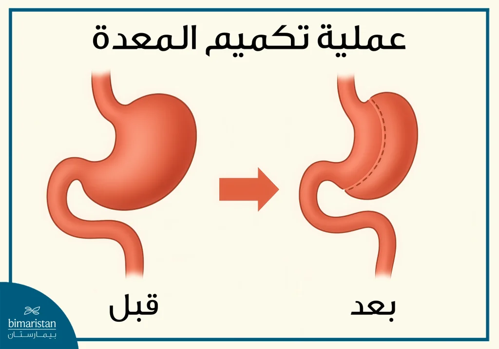 الفرق بين تحويل مسار البنكرياس وتكميم المعدة 3 توضح الصورة عملية تكميم المعدة