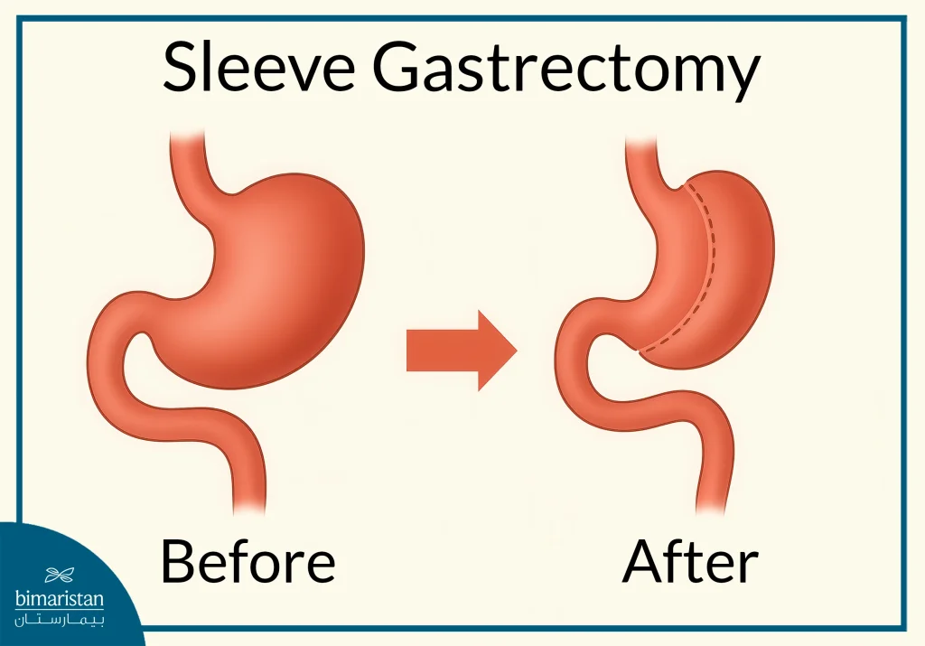The Image Illustrates The Sleeve Gastrectomy Procedure