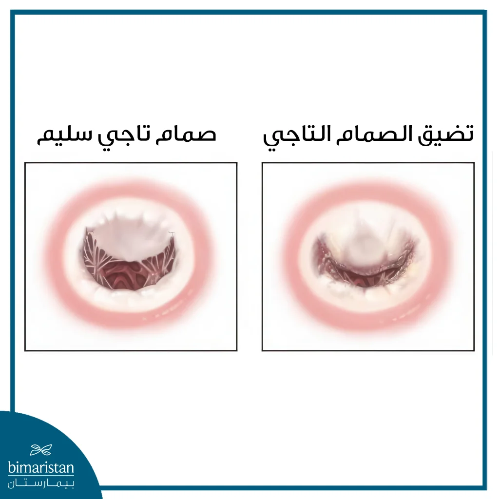 الفرق بين تضيق الصمام الأبهري والميترالي: الأعراض والتشخيص والعلاج 4 صورة توضح الفرق بين الصمام المتضيق والصمام السليم