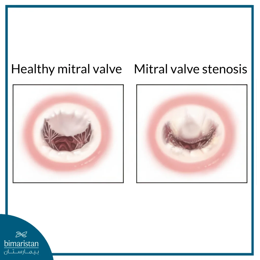 Aortic Vs Mitral Valve Stenosis: Symptoms, Diagnosis And Treatment 4 An Image Showing The Difference Between A Stenotic Mitral Valve And A Healthy Mitral Valve