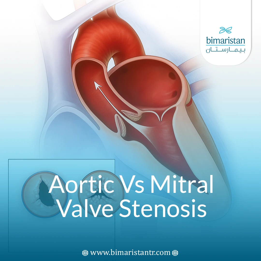 Aortic vs Mitral Valve Stenosis: Symptoms and Key Treatments