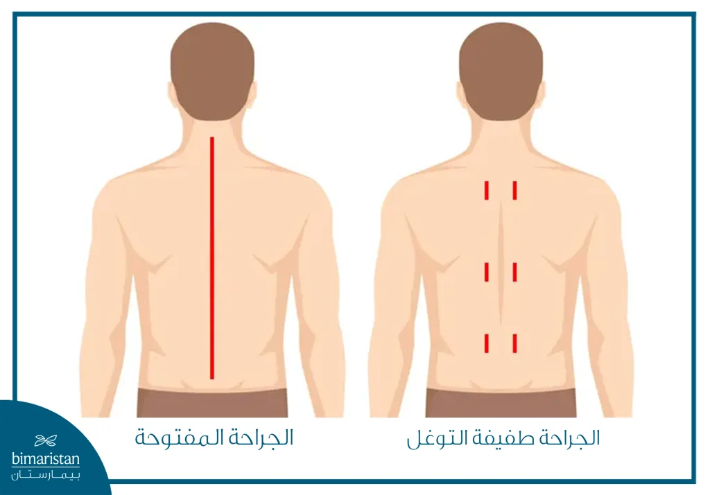 جراحة العمود الفقري طفيفة التوغل 11 الفرق بين حجم الشق بالجراحة المفتوحة وطفيفة التوغل