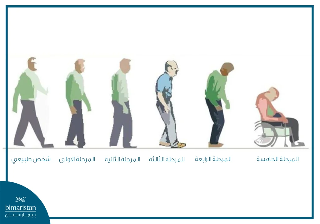 المراحل الخمسة لمرض باركنسون