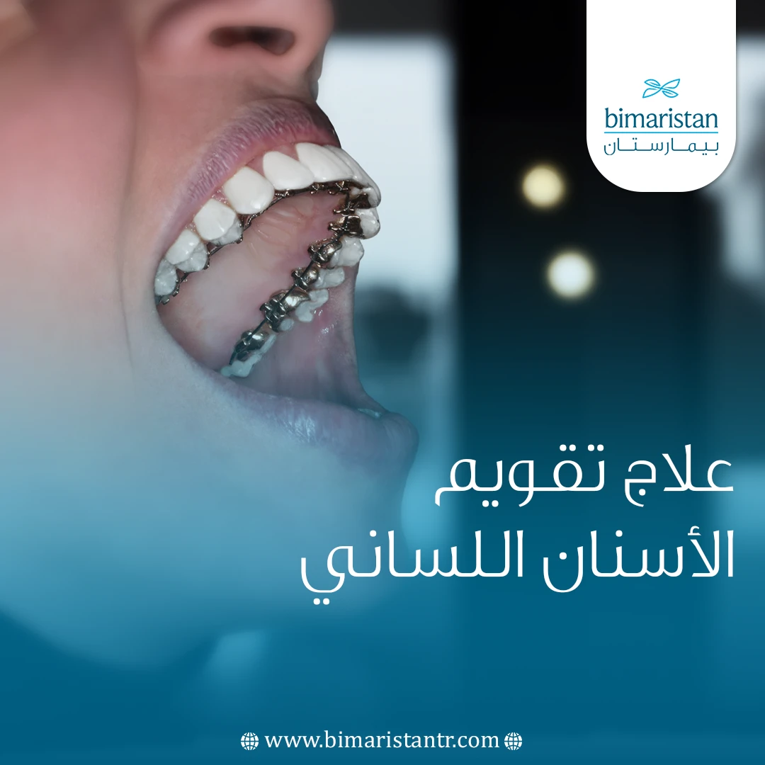 علاج تقويم الأسنان اللساني