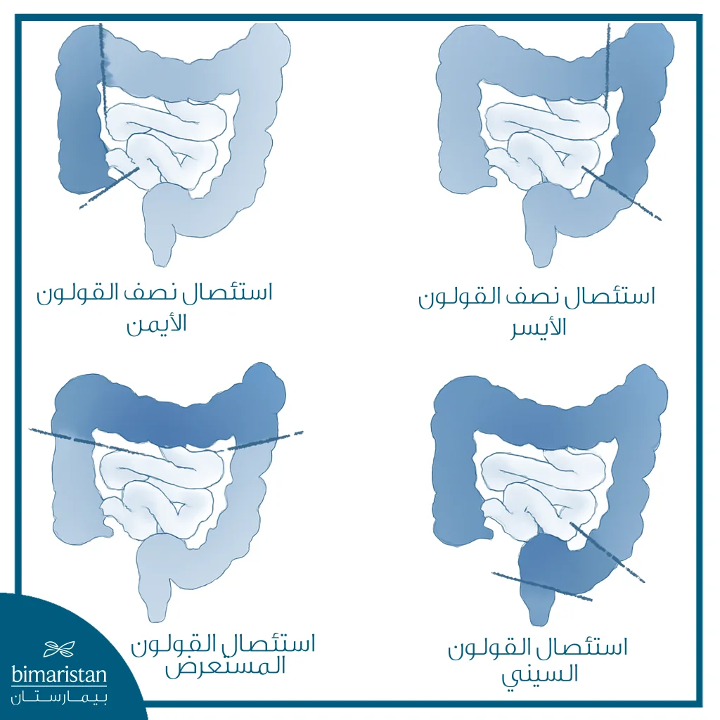 استئصال القولون الجزئي: متى يُنصح به وما نتائج الجراحة؟ 4 توضح الصورة أنواع استئصال القولون الجزئي