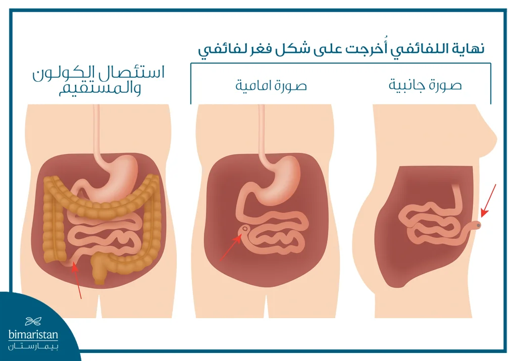 علاج التهاب القولون التقرحي في تركيا 6 توضح الصورة عملية استئصال القولون والمستقيم والشرج مع فغر نهائي للفائفي