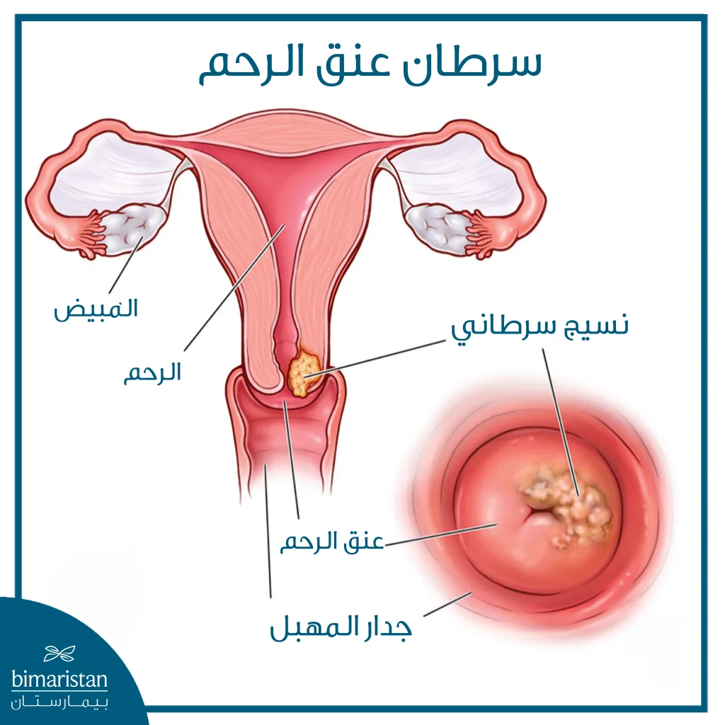 توضح الصورة موقع سرطان عنق الرحم في أسفل الرحم، حيث تنمو الخلايا السرطانية في منطقة الاتصال بين الرحم والمهبل.