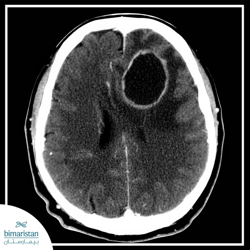 Brain Abscess Surgery Explained: Steps, Risks, And Outcomes 4 A Ct Scan Image Showing A Brain Abscess