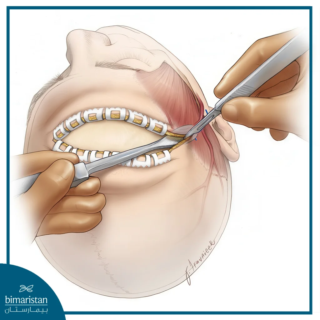 Brain Abscess Surgery Explained: Steps, Risks, And Outcomes 5 An Illustration Showing Open Brain Abscess Surgery