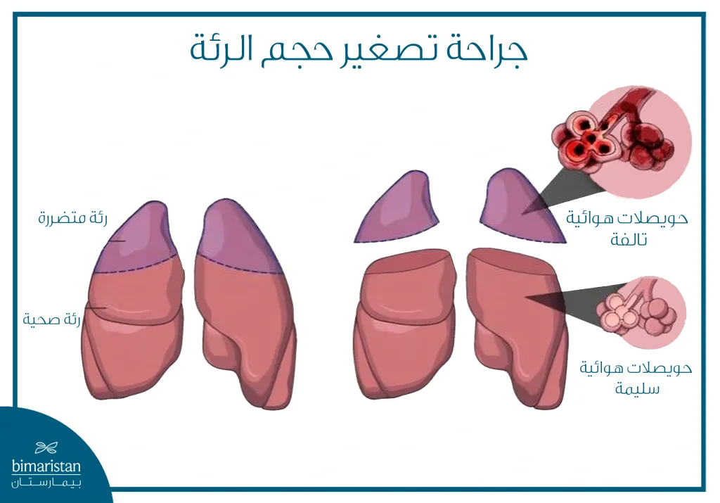 علاج الانسداد الرئوي المزمن الناتج عن التدخين جراحياً بواسطة التنظير 4 جراحة تصغير حجم الرئة