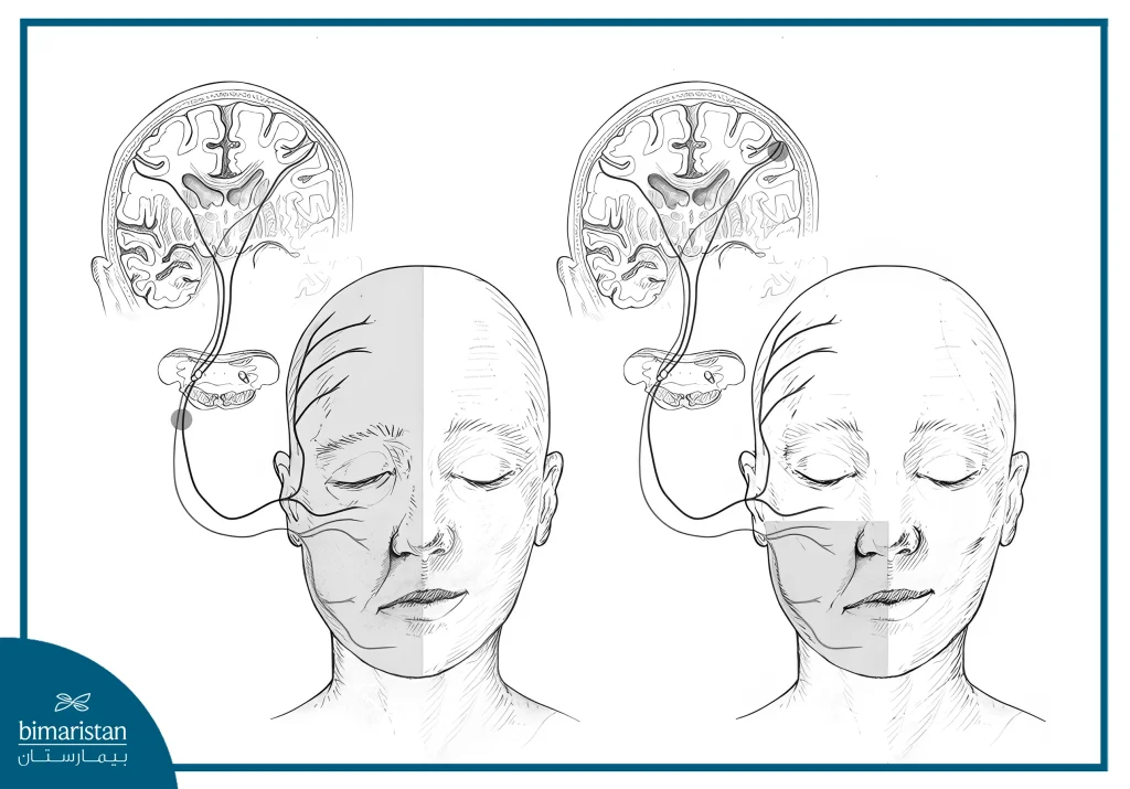 Illustration Showing Bell'S Palsy