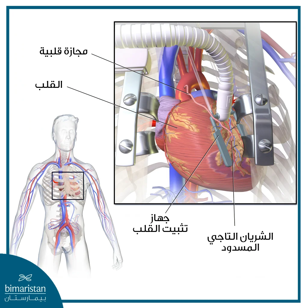 رسم توضيحي لعملية جراحة مجازة الشريان التاجي بدون مضخة (Opcab) يُظهر القلب النابض أثناء الجراحة، مع استخدام أداة التثبيت وموضع الطُعم الذي يتجاوز الشريان التاجي المسدود.