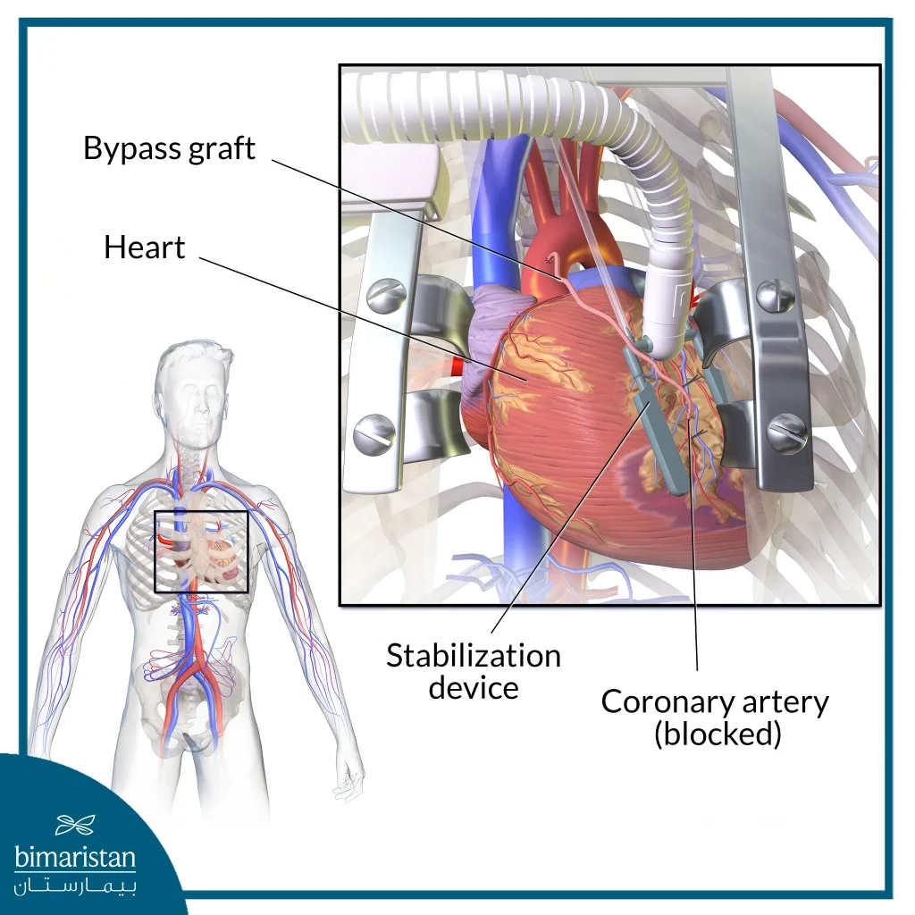 Off-Pump Coronary Bypass Surgery: Benefits, Procedure, Risks, And Success Rates 3 Illustration Of Off-Pump Coronary Bypass Graft (Opcab) Surgery Showing The Beating Heart During Surgery, The Use Of A Stent, And The Position Of The Graft Bypassing The Blocked Coronary Artery.