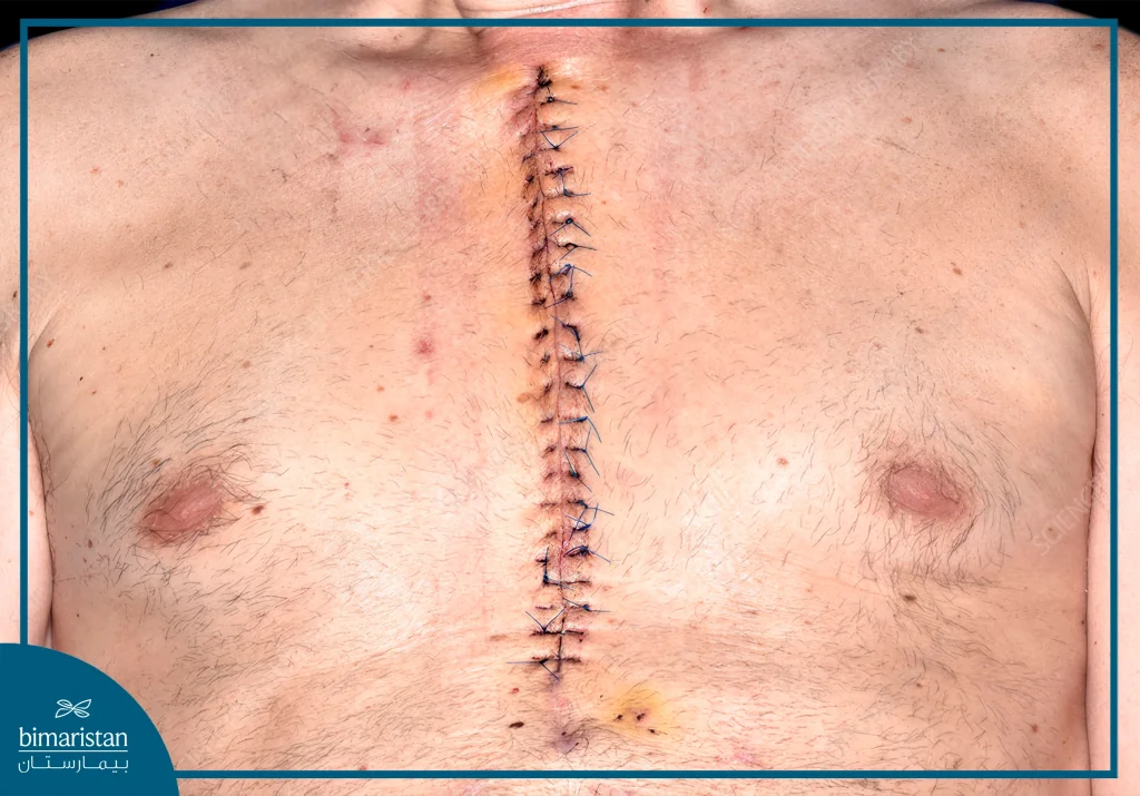 Off-Pump Coronary Bypass Surgery: Benefits, Procedure, Risks, And Success Rates 5 Image Showing The Surgical Incision That Was Closed After The Sternum Was Fixed With Surgical Wires.