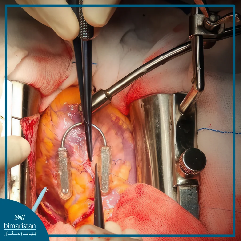 Off-Pump Coronary Bypass Surgery: Benefits, Procedure, Risks, And Success Rates 4 Close-Up Image Showing The Appearance Of The Stent Device Used During Off-Pump Coronary Bypass Surgery To Stabilize A Specific Part Of The Beating Heart And Reduce Its Movement.
