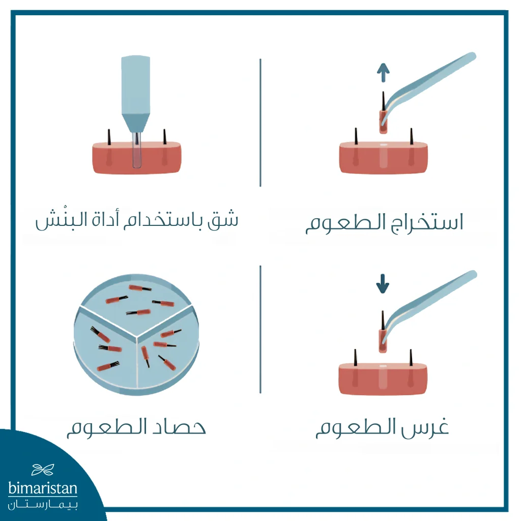 خطوات زراعة الشعر بتقنية Fue مع اقتطاف البصيلات الفردية وزرعها في المناطق المستهدفة