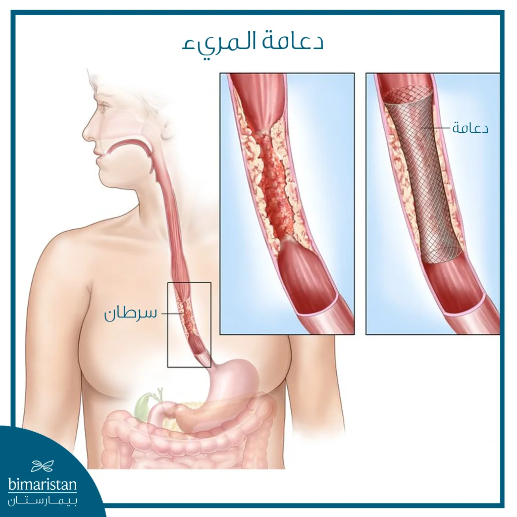 دعامة المريء
