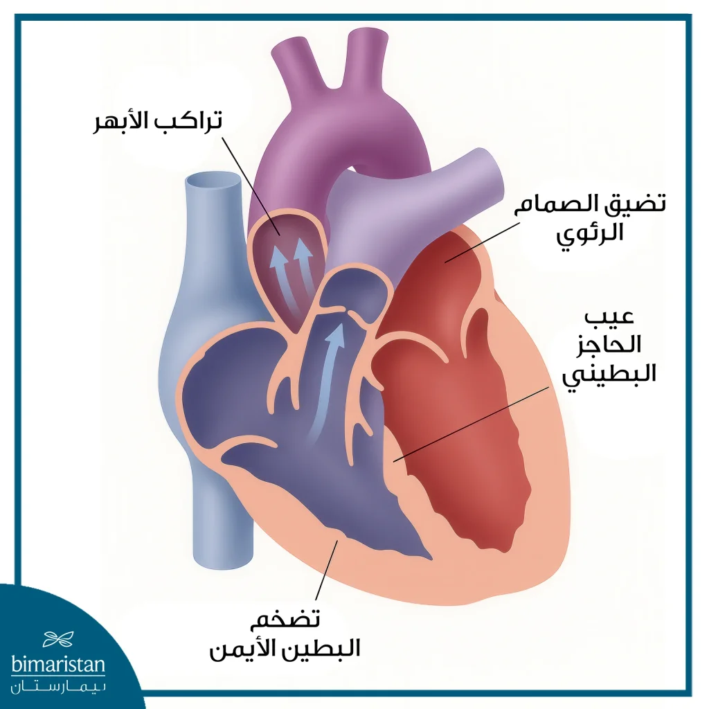 رسم طبي يوضح مكونات رباعي فالو في القلب