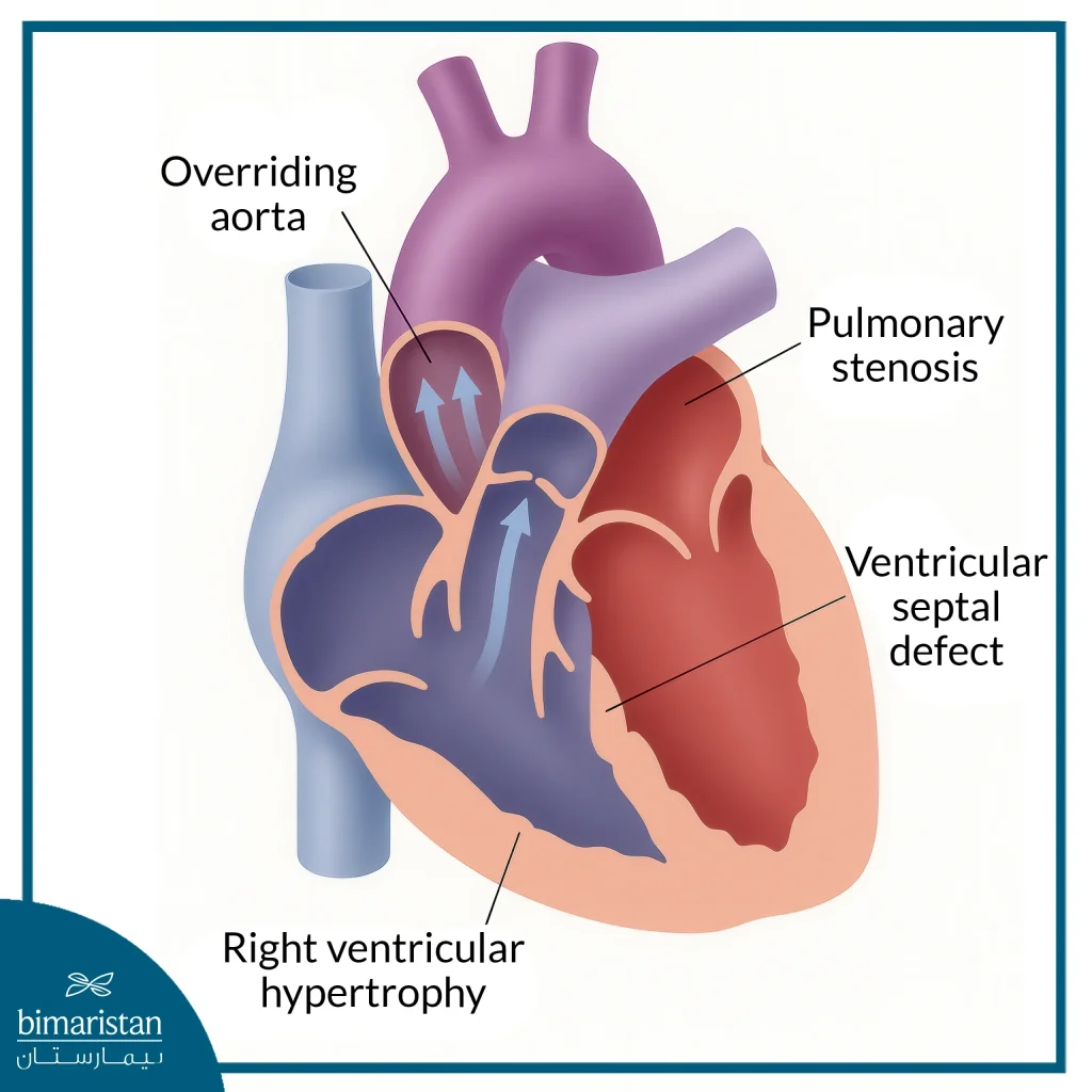 Tetralogy Of Fallot In Children: Symptoms, Diagnosis, And Surgery Options 3 Medical Illustration Showing The Primary Defects Of A Tetralogy Of Fallot In The Heart