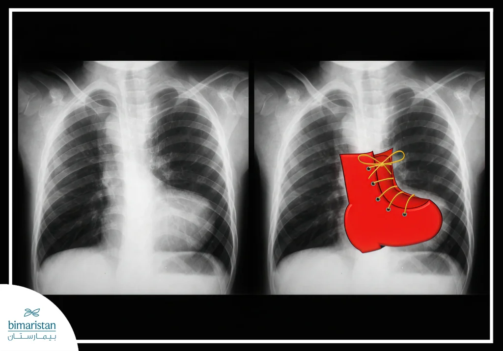 Tetralogy Of Fallot In Children: Symptoms, Diagnosis, And Surgery Options 5 An X-Ray Image Of A Patient With Tetralogy Of Fallot, Showing The Heart'S Shape, Which Appears Shoe-Shaped Due To Right Ventricular Hypertrophy.