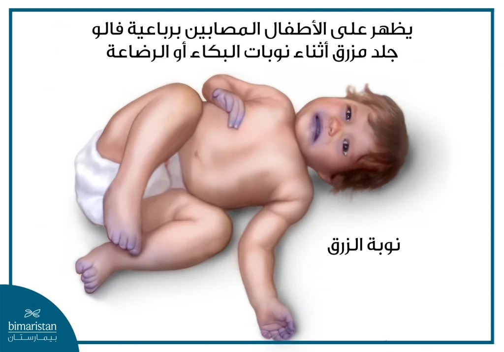 صورة توضح رضيع يعاني من نوبة زرق ناتجة عن رباعي فالو، يظهر عليه تغيّر لون الجلد والشفاه إلى الأزرق بسبب نقص الأكسجين.