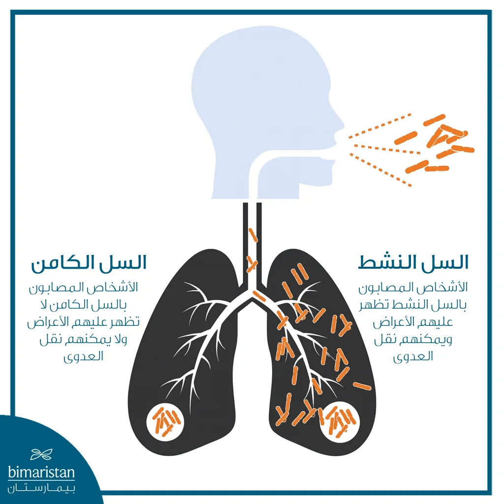 ما هو مرض السل؟ الأسباب، الأنواع، وآلية العدوى 4 رسم توضيحي يشرح الفرق بين السل الكامن والنشط
