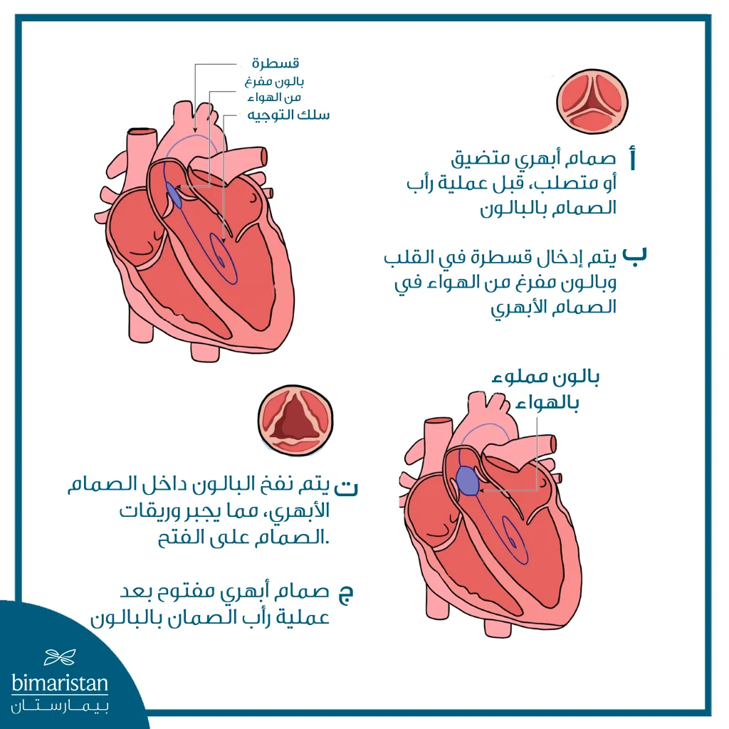 رأب الصمام بالبالون: تقنية آمنة لتوسيع صمامات القلب المتضيقة 4 رسم يوضح مراحل رأب الصمام الأبهري بالبالون داخل القلب