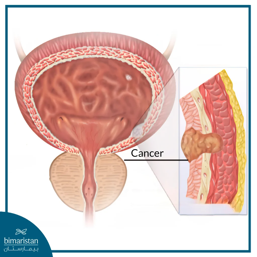 An Image Illustrating Bladder Cancer