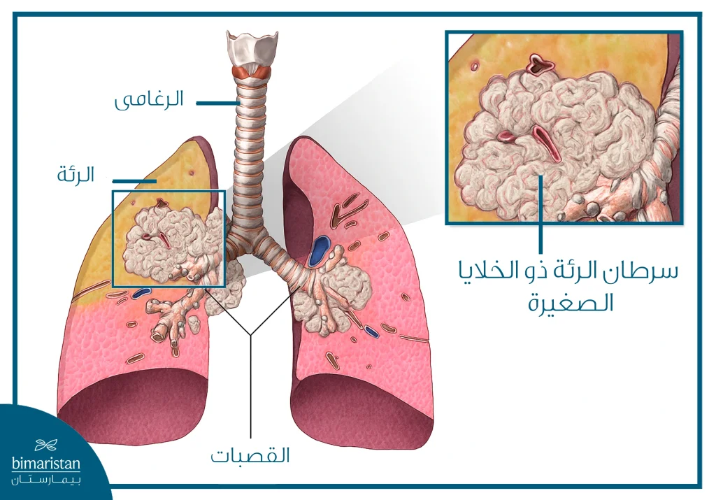 سرطان الرئة ذو الخلايا الصغيرة 