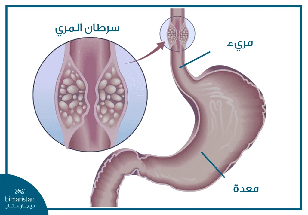 سرطان المريء