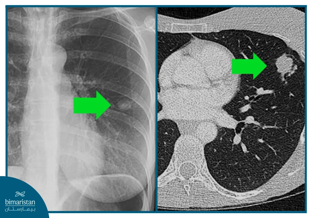 تشخيص مرض السل: أحدث طرق الكشف والفحوص المخبرية 5 صورة أشعة سينية ومقطعية تُستخدم في تشخيص مرض السل وتُظهر بؤرة إصابة في الرئة
