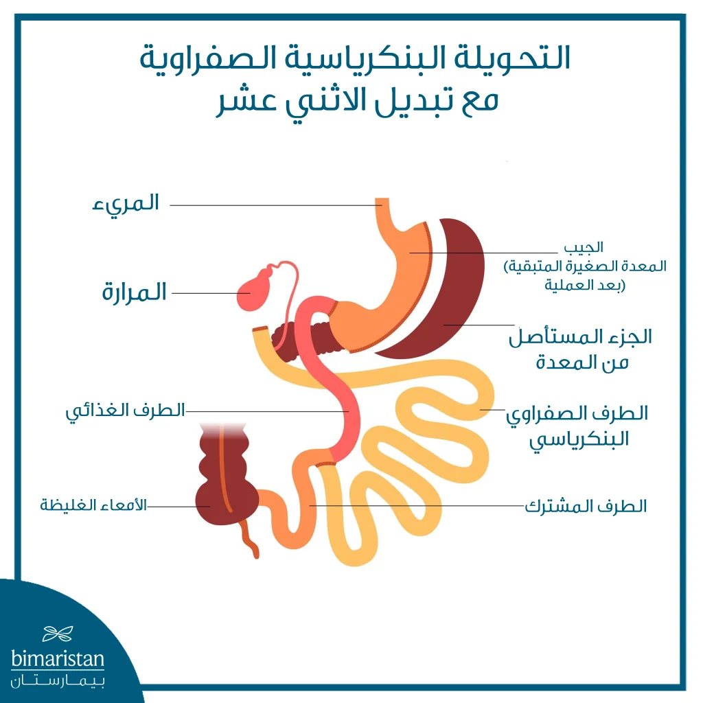 الفرق بين تحويل مسار البنكرياس وتكميم المعدة 4 صورة بعد عملية تحويل مسار البنكرياس والقنوات الصفراوية مع تبديل مسار الإثني عشر (Bpd-Ds)