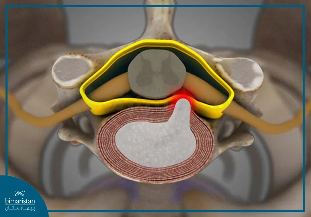 أسباب ديسك الرقبة: أبرز العوامل وراء الانزلاق الغضروفي العنقي 4 صورة تظهر ضغط القرص المنفتق على عصب شوكي