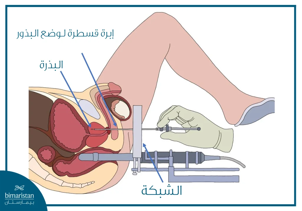 صورة توضح آلية المعالجة الكثبية (الإشعاع الداخلي) أحد أشكال العلاج الإشعاعي لسرطان البروستاتا