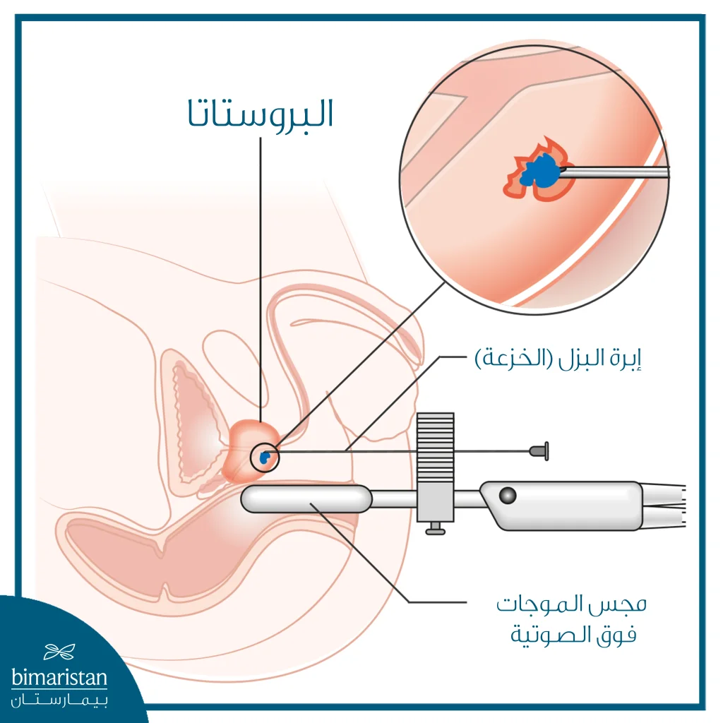 صورة توضح إجراء خزعة البروستاتا عبر المستقيم الموجّهة بالأمواج فوق الصوتية