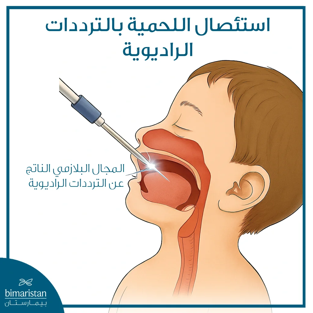 علاج تضخم اللحمية عند الأطفال 3 صورة توضح استئصال اللحمية عبر الترددات الراديوية
