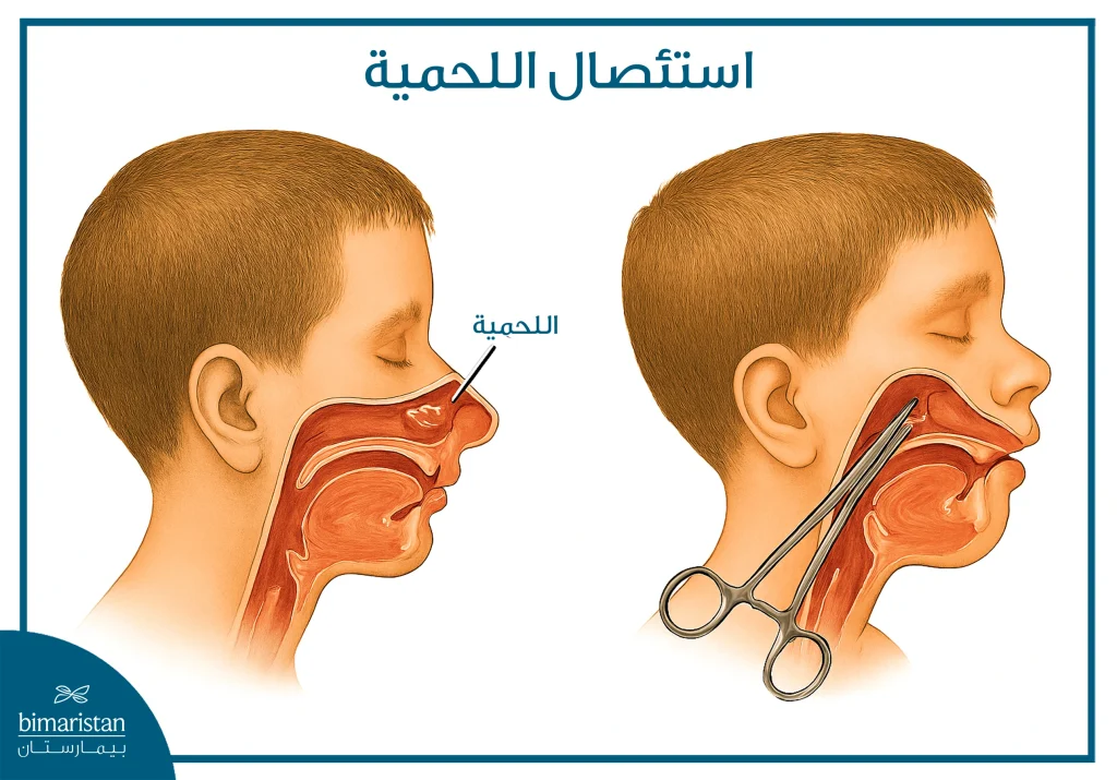 علاج تضخم اللحمية عند الأطفال 2 صورة توضح استئصال اللحمية عن طريق الجراحة