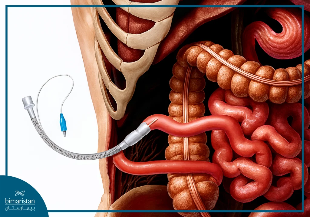 علاج التهاب القولون التقرحي في تركيا 5 صورة توضح استخدام Wafi Procedure كبديل مؤقت وآمن