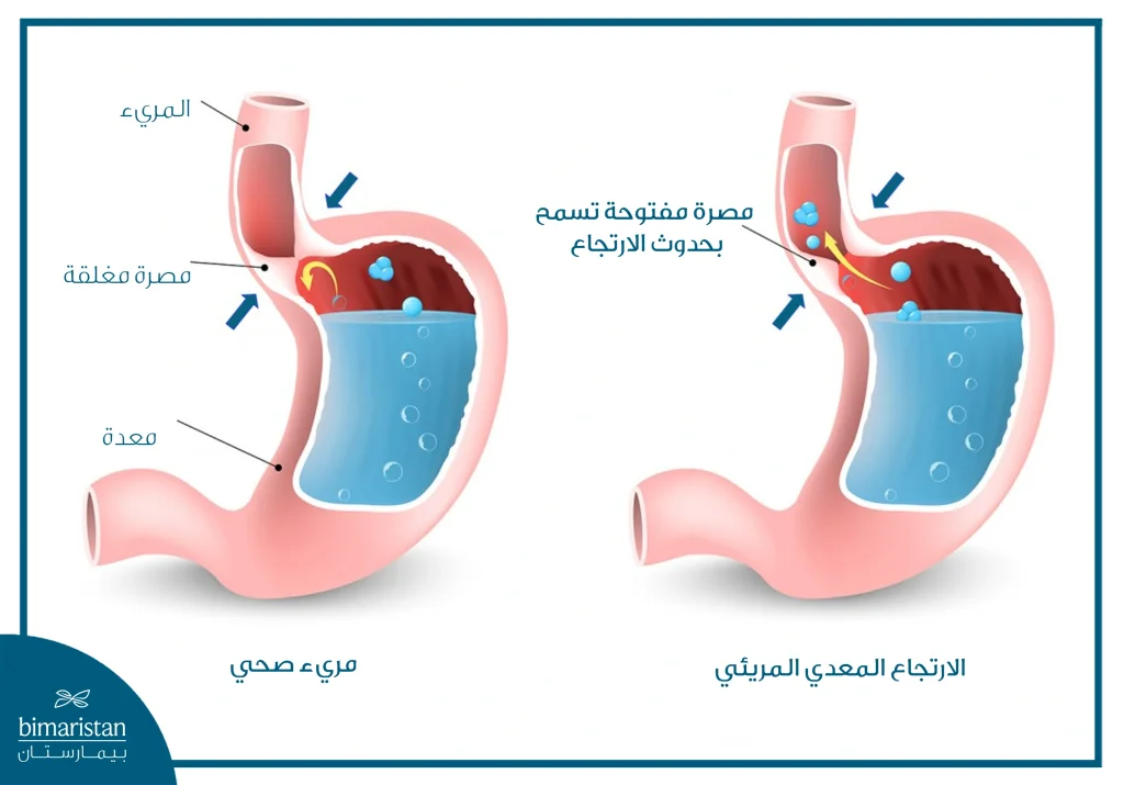 بوتوكس المعدة في تركيا: أفضل علاج للسمنة 2025 5 الارتجاع المريئي المعدي: يعد من المضاعفات التي قد تظهر بعد إجراء بوتوكس المعدة