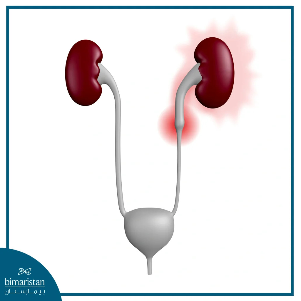 صورة توضح الحصية في الحالب